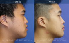 before and after orthognathic side view surgery case 2061