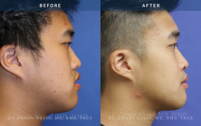 before and after orthognathic side view surgery case 2061