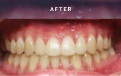 after orthognathic surgery case 2061