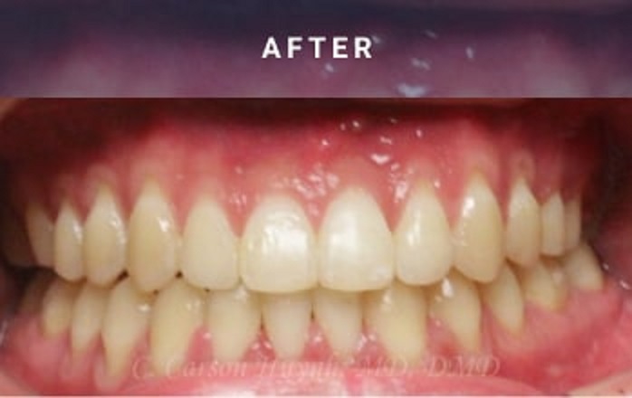 after orthognathic surgery case 2061