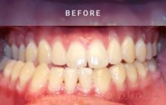 before orthognathic surgery case 2061