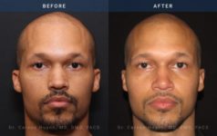 Before and After Rhinoplasty male patient front angle view Case 1866