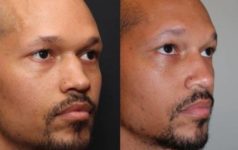 Before and After Rhinoplasty male patient diagonal angle view Case 1866