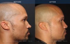 Before and After Rhinoplasty male patient side angle view Case 1866