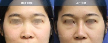 Before and After Rhinoplasty female patient front angle view Case 1870