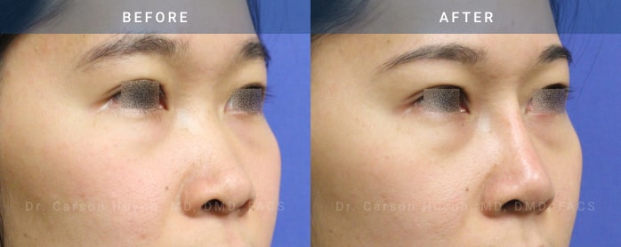 Before and After Rhinoplasty female patient diagonal angle view Case 1870