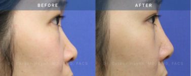 Before and After Rhinoplasty female patient side angle view Case 1870