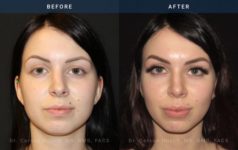 Before and After Rhinoplasty front angle view Case 1874