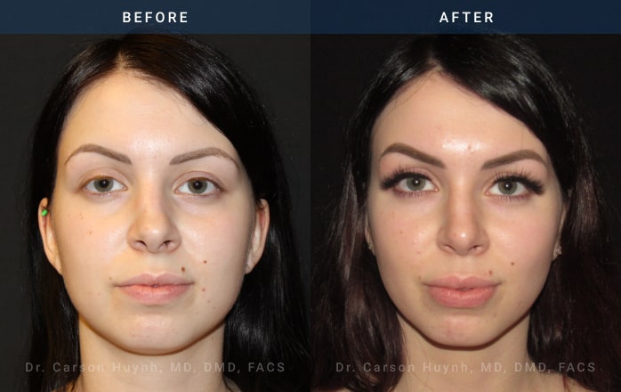 Before and After Rhinoplasty front angle view Case 1874
