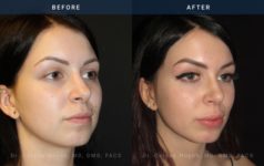Before and After Rhinoplasty diagonal angle view Case 1874