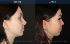 Before and After Rhinoplasty side angle view Case 1874