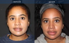 Before and After Rhinoplasty female patient front angle view Case 1882