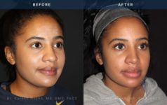 Before and After Rhinoplasty female patient diagonal angle view Case 1882