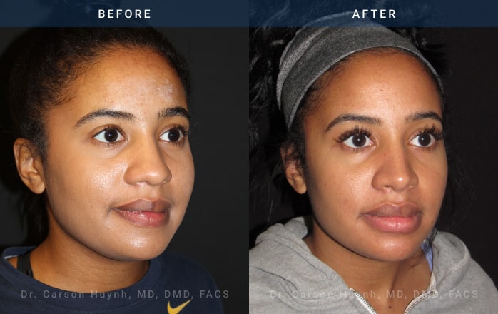 Before and After Rhinoplasty female patient diagonal angle view Case 1882