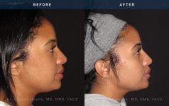 Before and After Rhinoplasty female patient side angle view Case 1882
