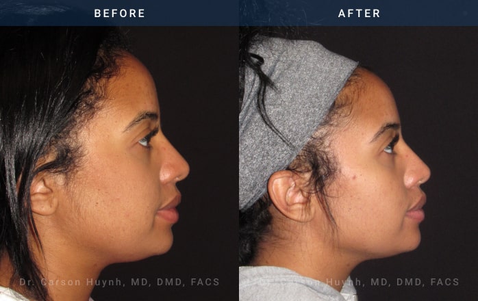 Before and After Rhinoplasty female patient side angle view Case 1882