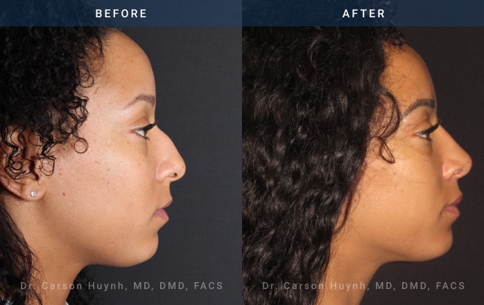 Before and After Rhinoplasty female patient side angle view Case 1898