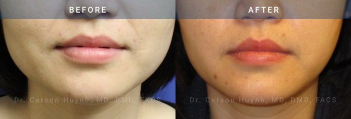 before and after before and after v-line jawline surgery case 2179