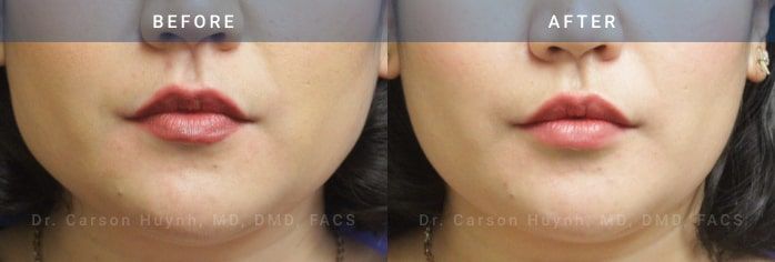 before and after v-line jawline surgery case 2181