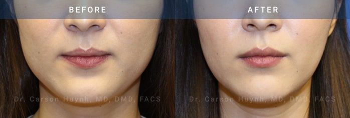 before and after v-line jawline surgery case 2183